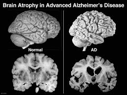 Esperança: nova droga para Alzheimer consegue reduzir neurodegeneração