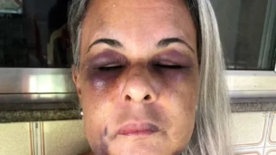 As marcas da agressão no rosto de Adriana Freitas Barreto — Foto: Arquivo pessoal